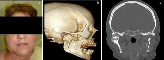 Osteom Rx