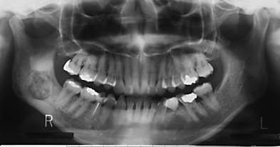 Osteoblastom dureros