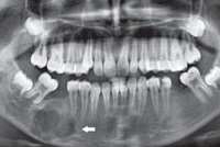 Osteoblastom Rx