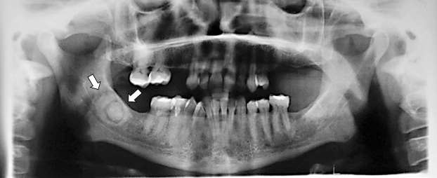 Osteomul osteoid Țintă