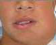 Fibrom osifiant RT