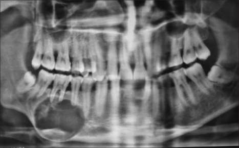 Fibrom osifiant mixt