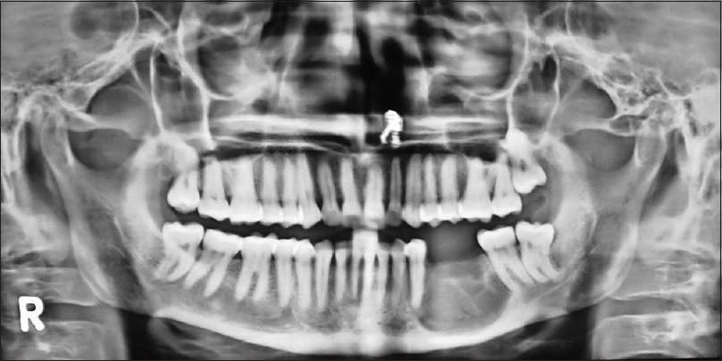 Condrom RT calcificări
