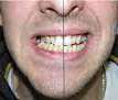Osteocondrom condilian