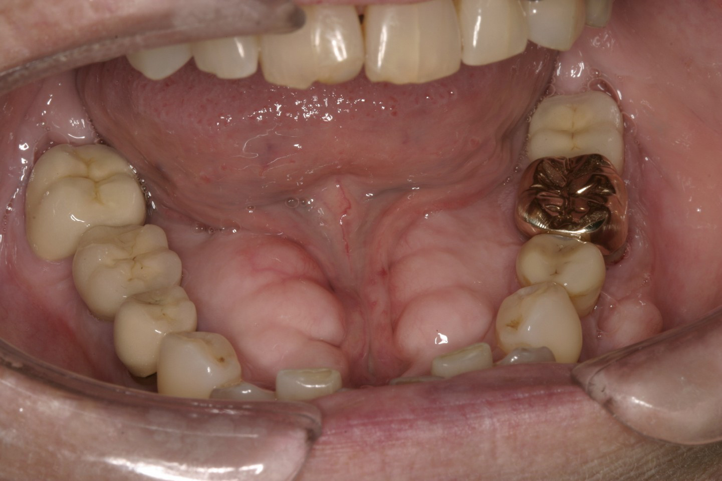 Torusul mandibular — localizare linguală