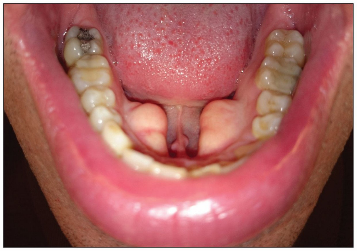 Torusul mandibular — bilateral