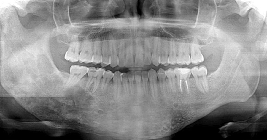 Displazia fibroasă — aspect radiologic