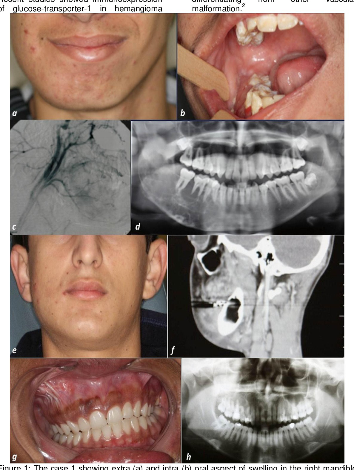Angiografie — malformație vasculară
