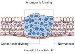 Carcinom spinocelular stadiu de debut