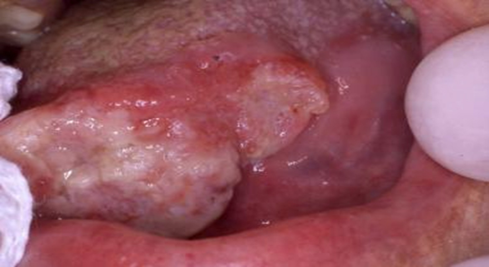 Carcinom schiros lingual