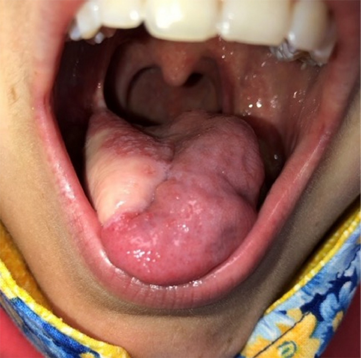 Aspect infiltrativ