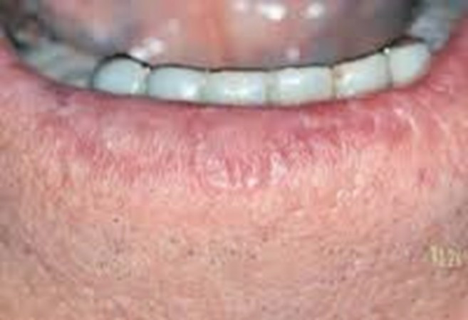 Fibrosarcom
