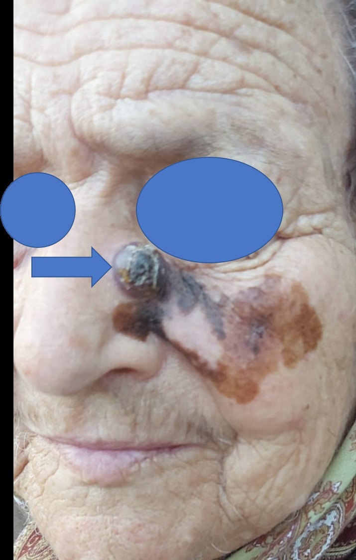 Nevul congenital