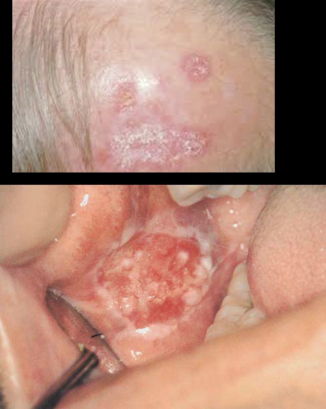 Lupus discoid tegumentar