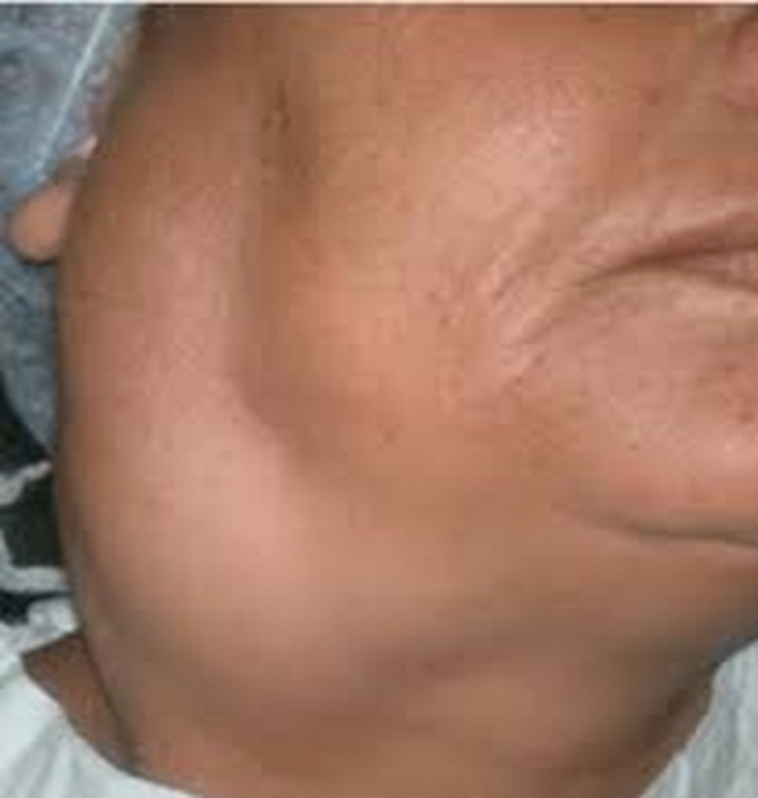 Adenopatia cervicală