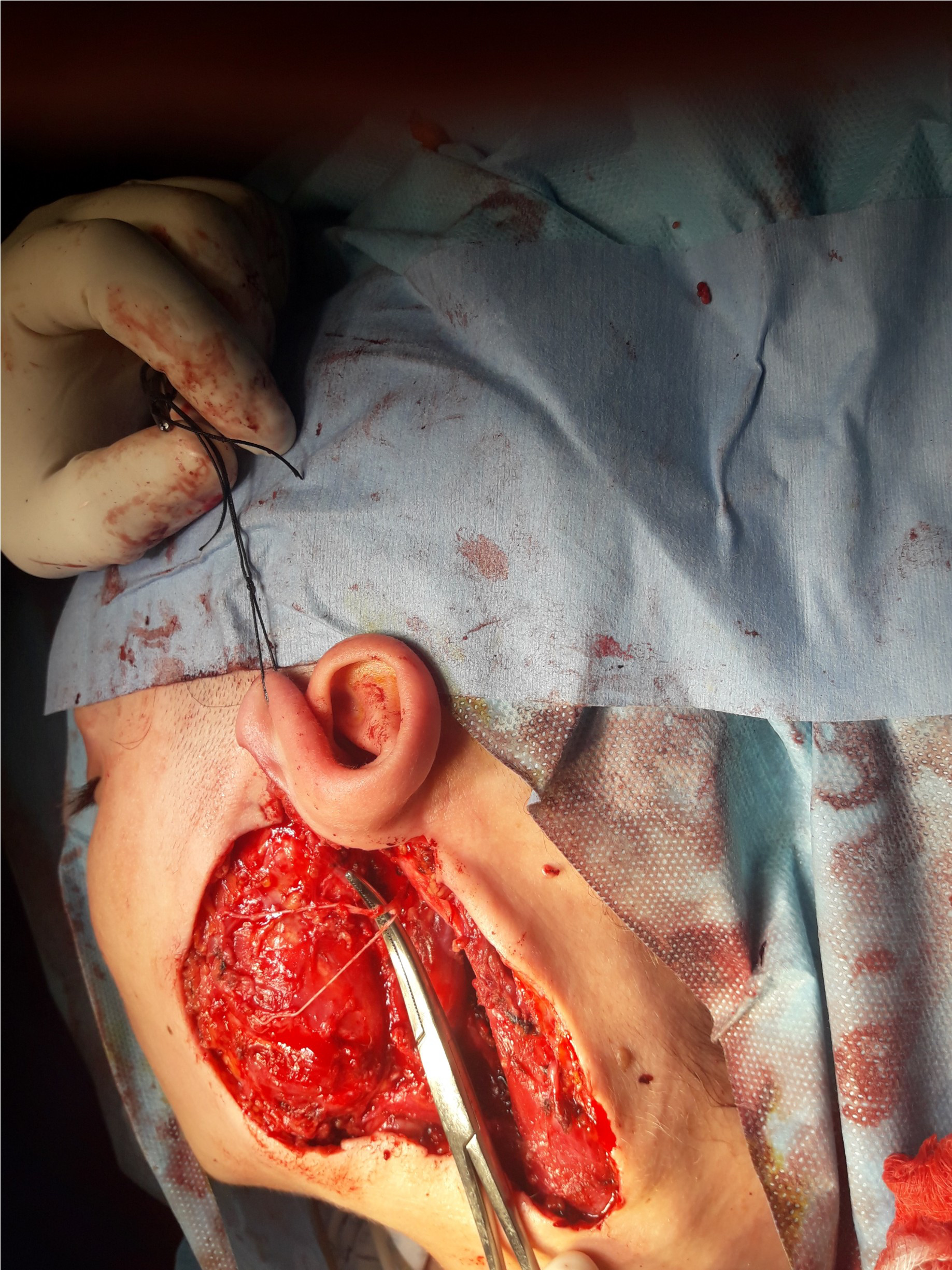 Lambou latissimus dorsi