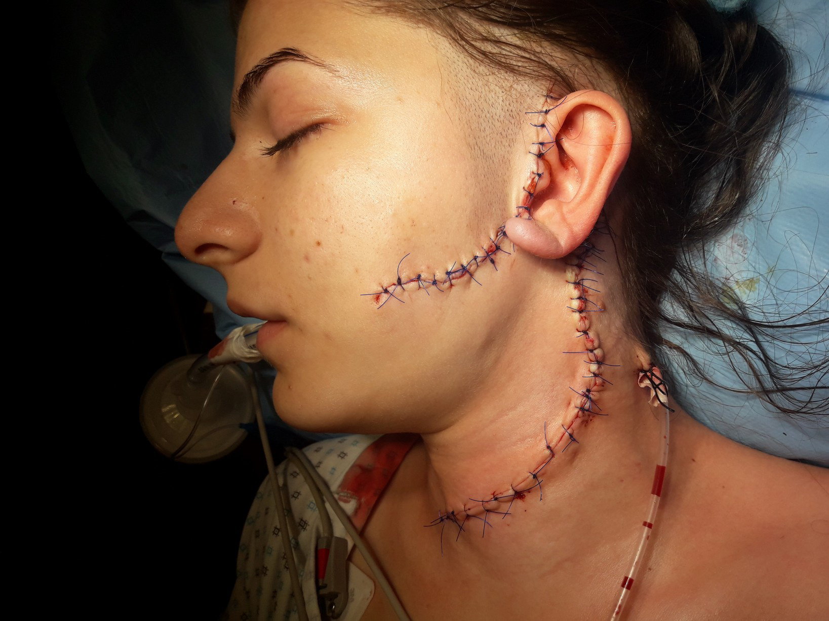 Lambou scapular