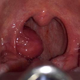 Aspect clinical HPV+