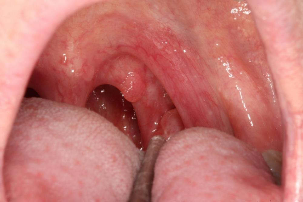 HPV+ aspect
