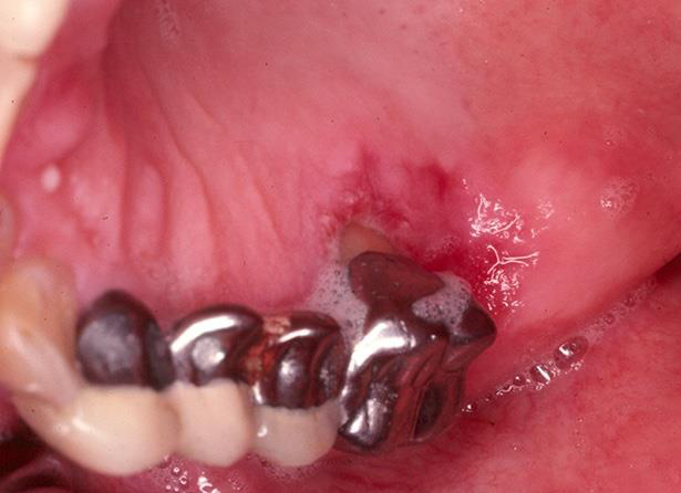 Gingival fixă dentat