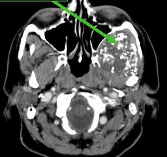 Aspect tumor