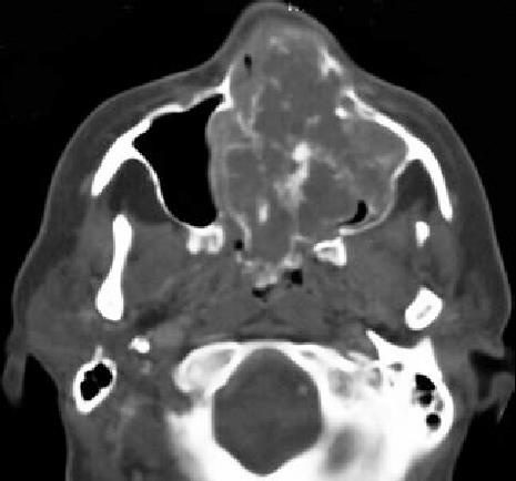Fibrosarcom