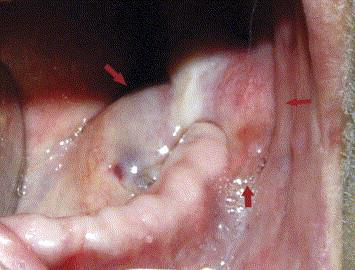 Angiosarcom