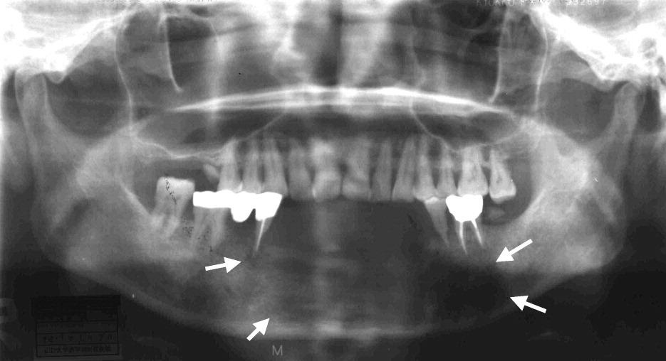 Carcinom odontogen