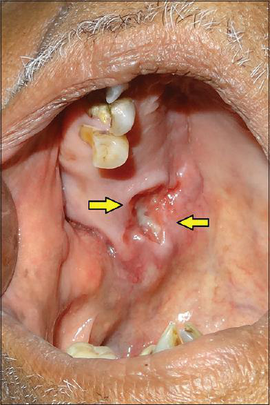 Dermatofibrosarcom