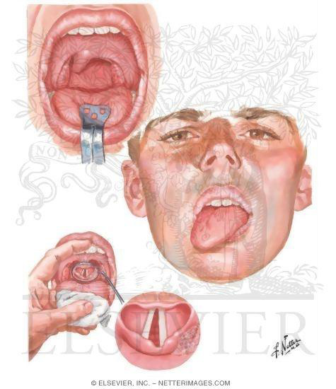 Paraliza faciala