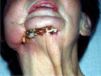 Fistula
