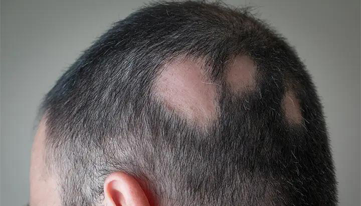 Xerostomia