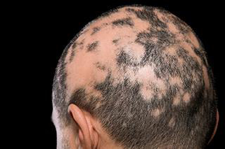 Alopecia