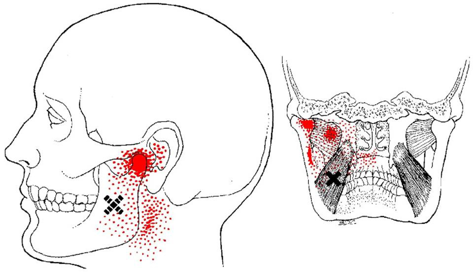 Puncte dureroase masticatori