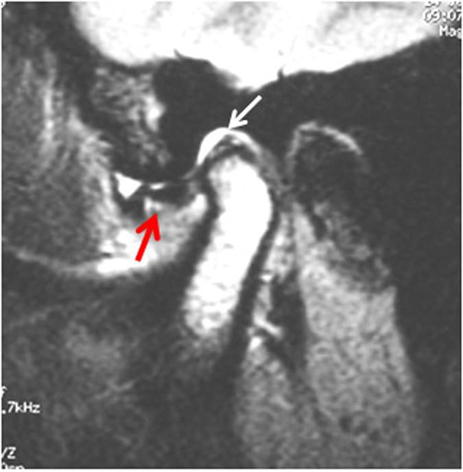 Osteofite artrozice