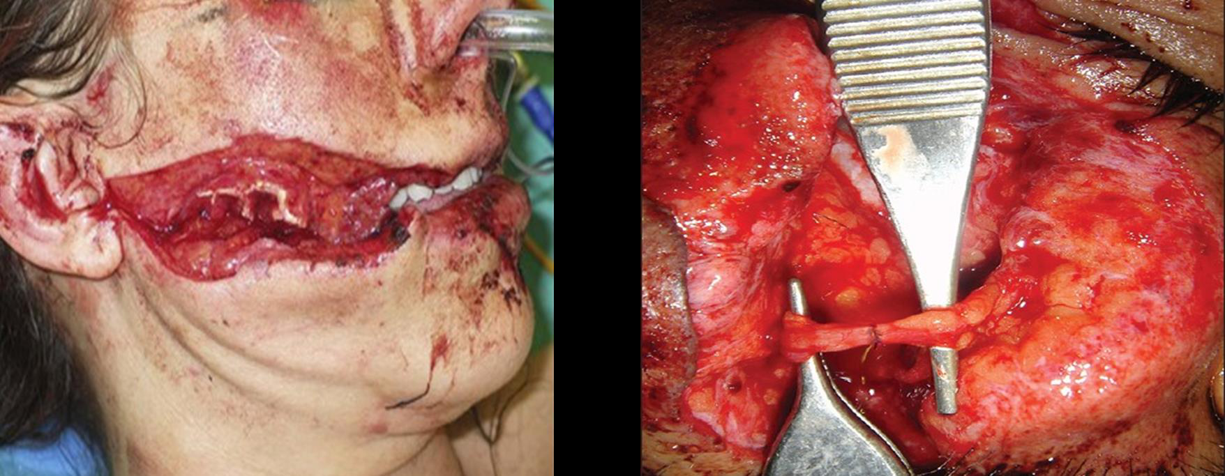 Traumatism parotidian cu plagă cervico-facială