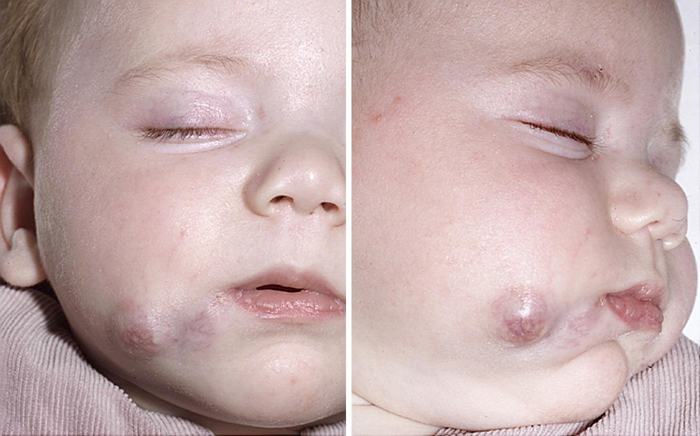Țesut salivar heterotopic facial