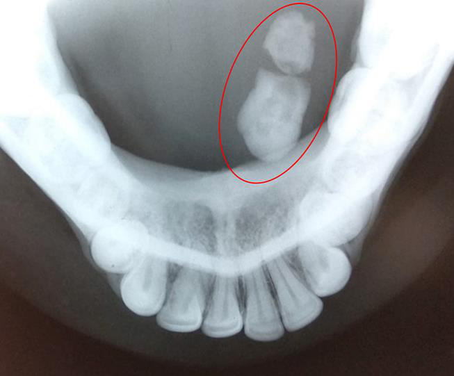 Radiografie cu calcul salivar