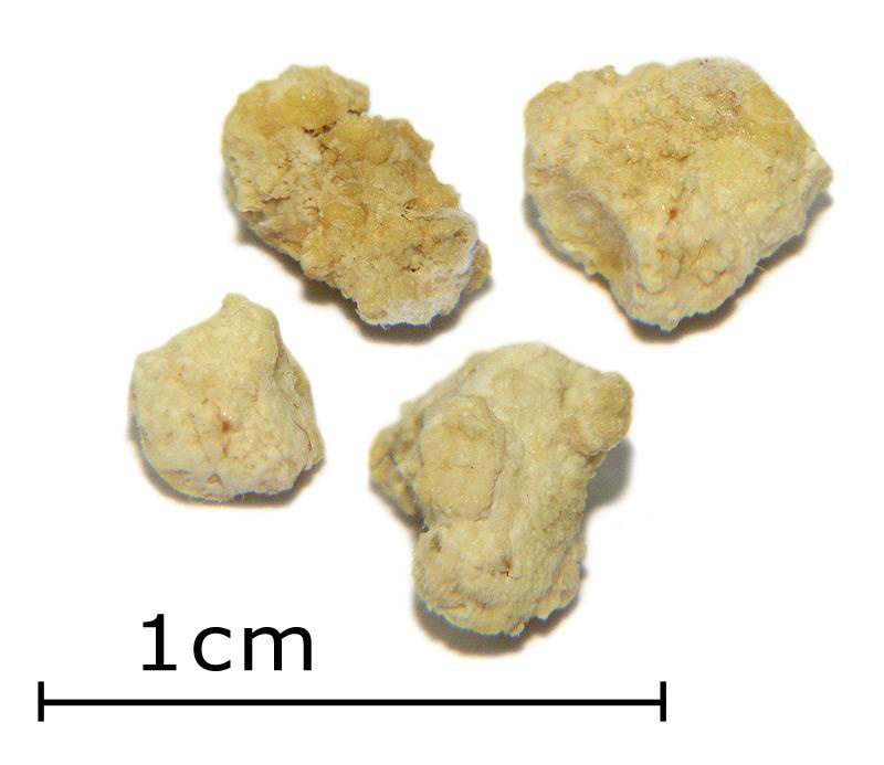 Calculi salivari extrași