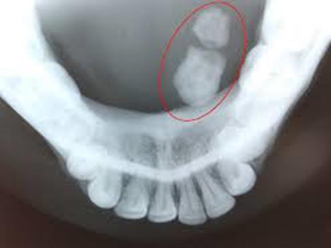 Radiografie ocluzală în litiază