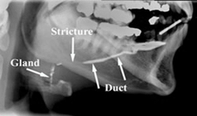 Sialografie duct stenozat