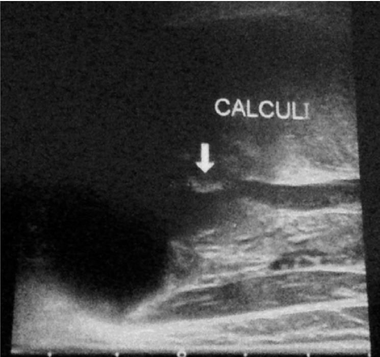 Ecografie calcul salivar