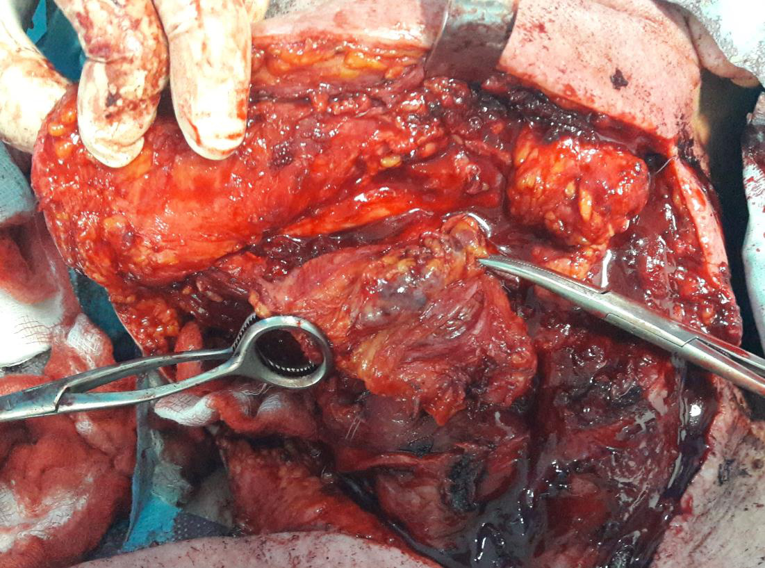 Abord chirurgical glandă submandibulară