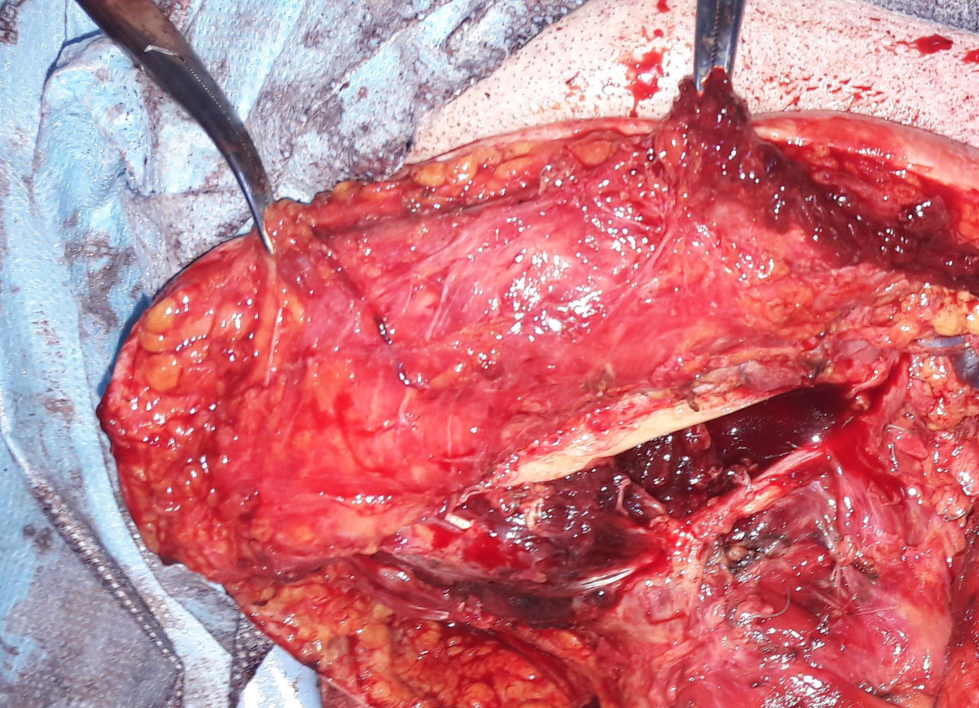 Submaxilectomie — piesă operatorie