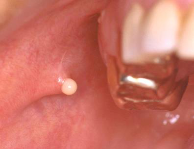 Puroi exteriorizat intraoral